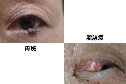 眼瞼良性腫瘍、悪性腫瘍